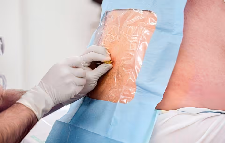 nerve block