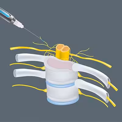 Illustration of a spinal injection procedure showing a syringe needle inserted near the spinal cord and nerve roots.