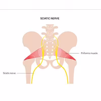 Diagram of the sciatic nerve and piriformis muscle in the lower back and pelvis region. The sciatic nerve is depicted in yellow, extending from the lower spine to the legs.