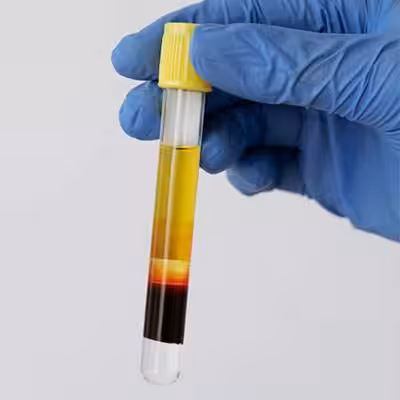A gloved hand holds a test tube containing separated blood components: a yellowish plasma layer on top and a darker red blood cell layer at the bottom.
