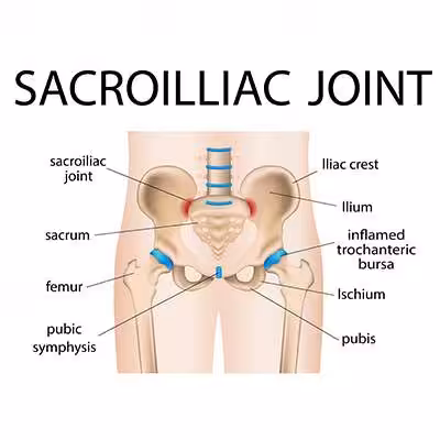 Detailed anatomical illustration of the sacroiliac joint, including labeled parts: ilium, ischium, pubis, femur, sacrum, pubic symphysis, iliac crest, and inflamed trochanteric bursa.